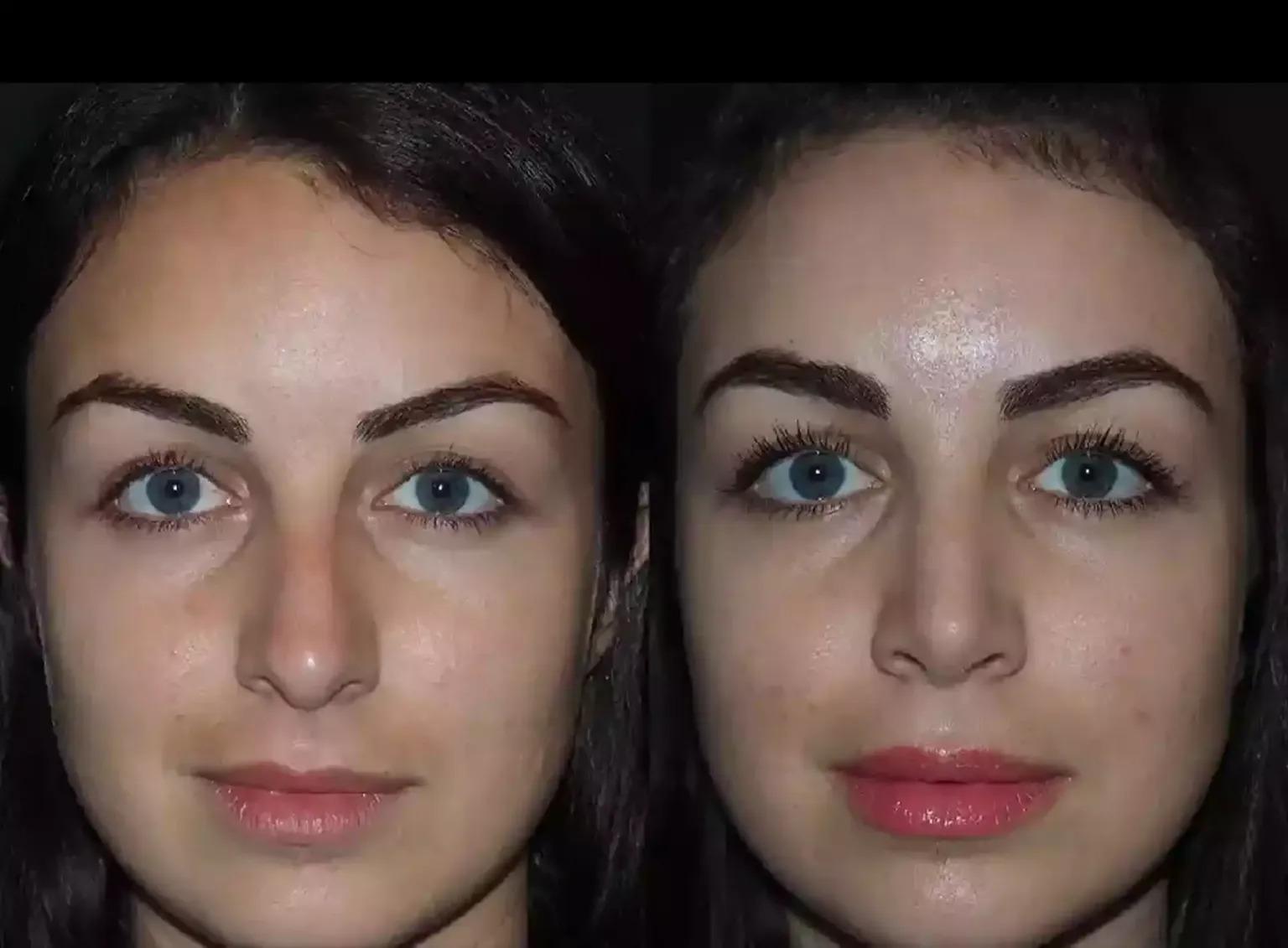 Septoplasty in Dubai