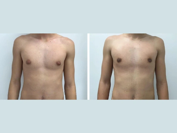 Gynecomastia in Dubai