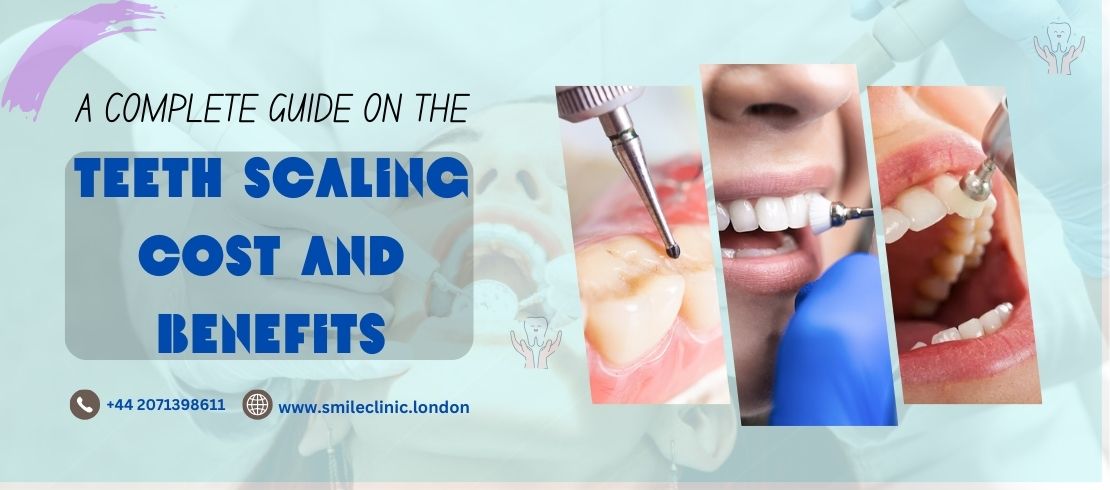 teeth scaling treatment in London