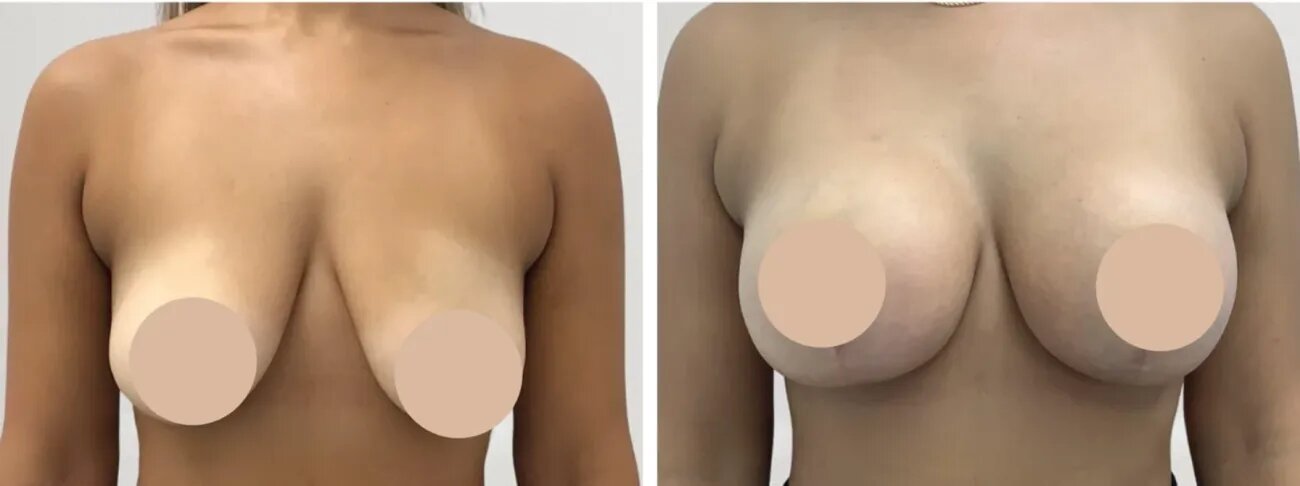 Breast Reduction Surgery in Dubai: Supporting Confidence with Surgical Precision