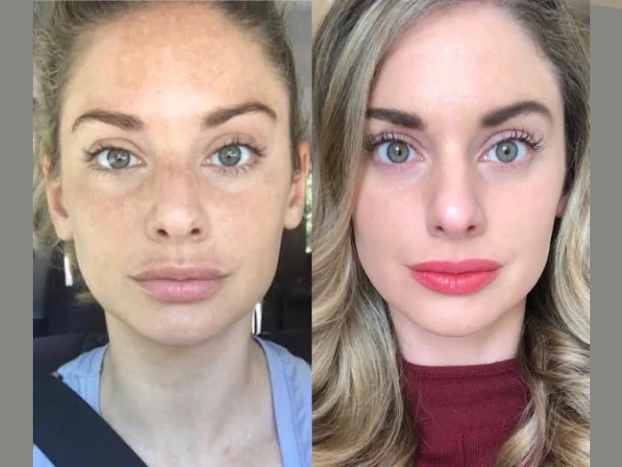 Advanced Skin Health with RF Microneedling Best Doctors in Dubai