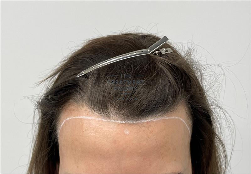 How Does the Hair Transplant Restore Receding Lines?